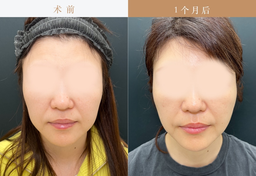 【 Vov lift 4根+Secret lift 10根】