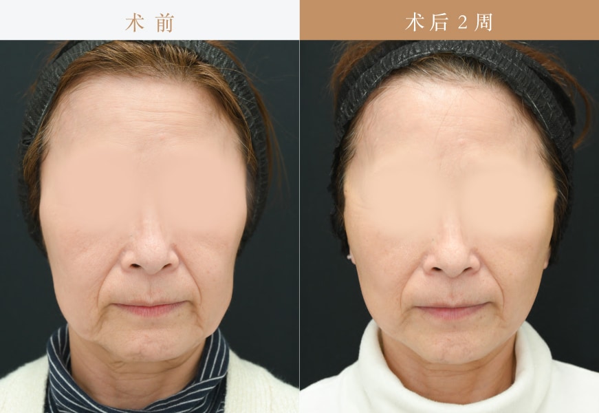 【Tess lift 6根+ Vov lift 6根】