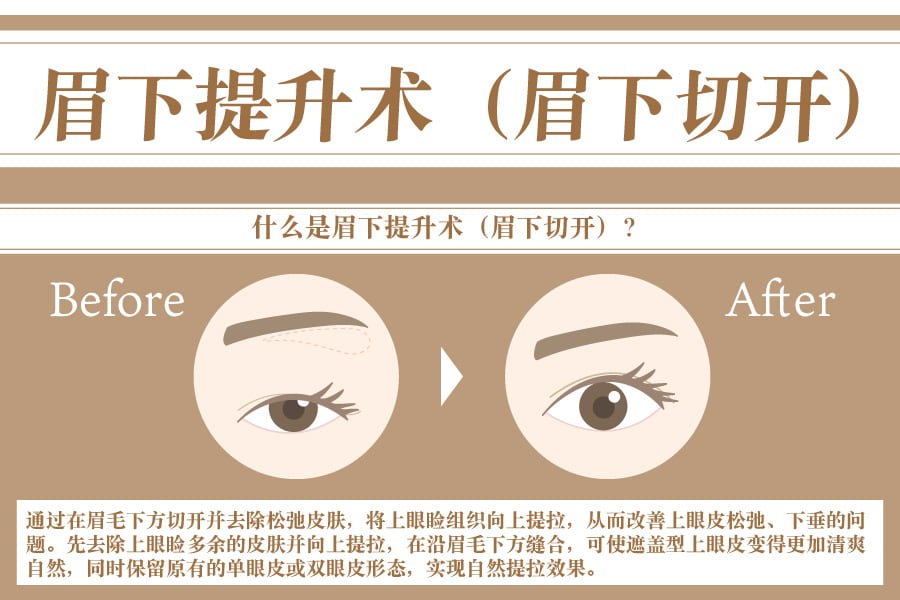 眼周抗衰护理｜什么是眉下提升术（眉下切开）？