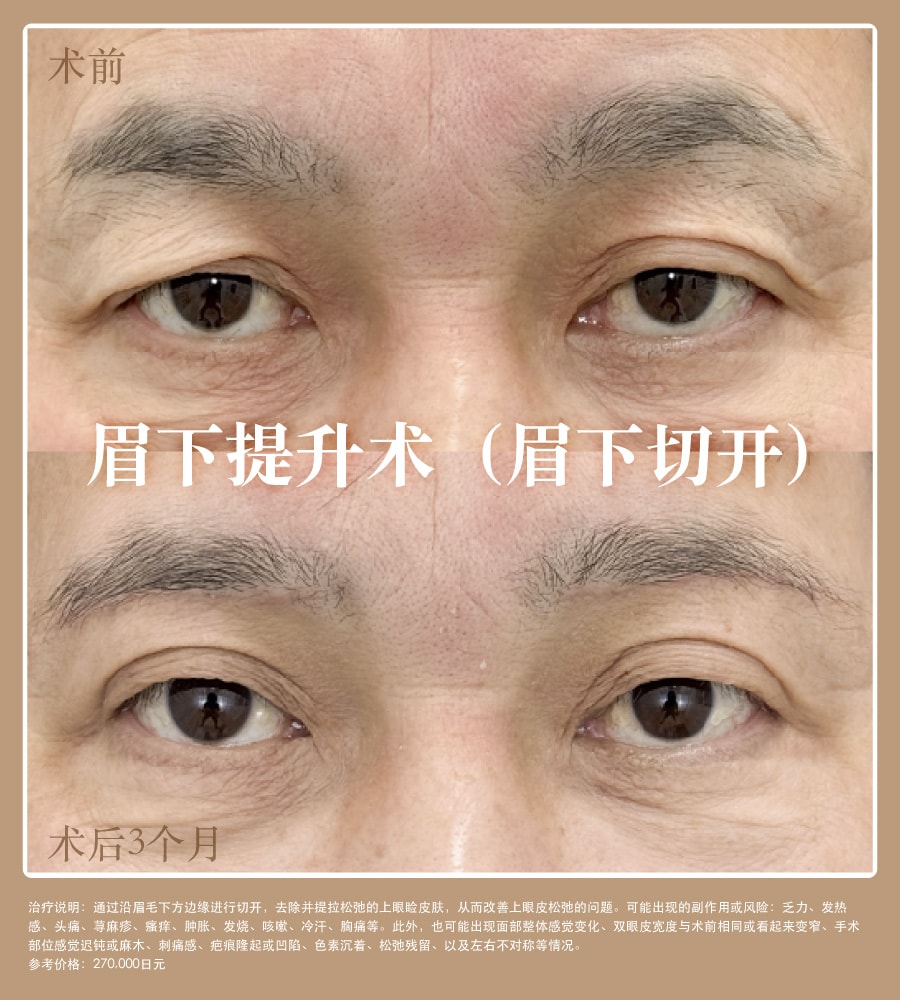 案例照片｜京都人气之选的眼周年轻化项目【眉下提升术】