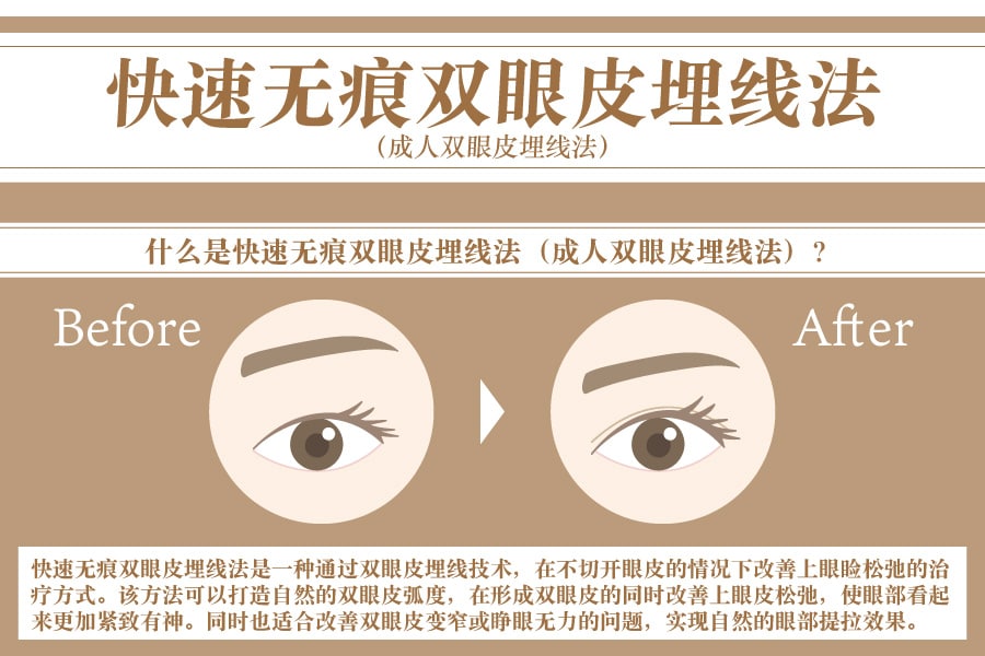 熟龄双眼皮术｜什么是快速无痕双眼皮埋线法？<br />
