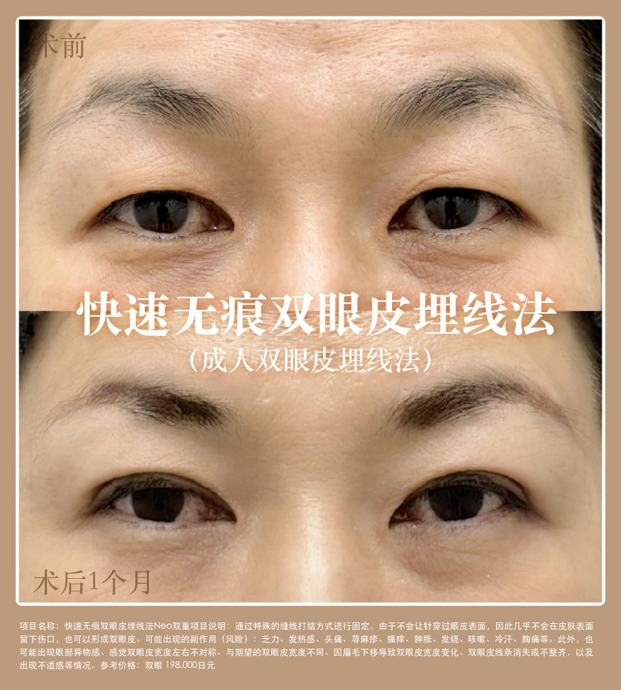 案例照片｜京都高人气埋线指定项目【快速无痕双眼皮埋线法】