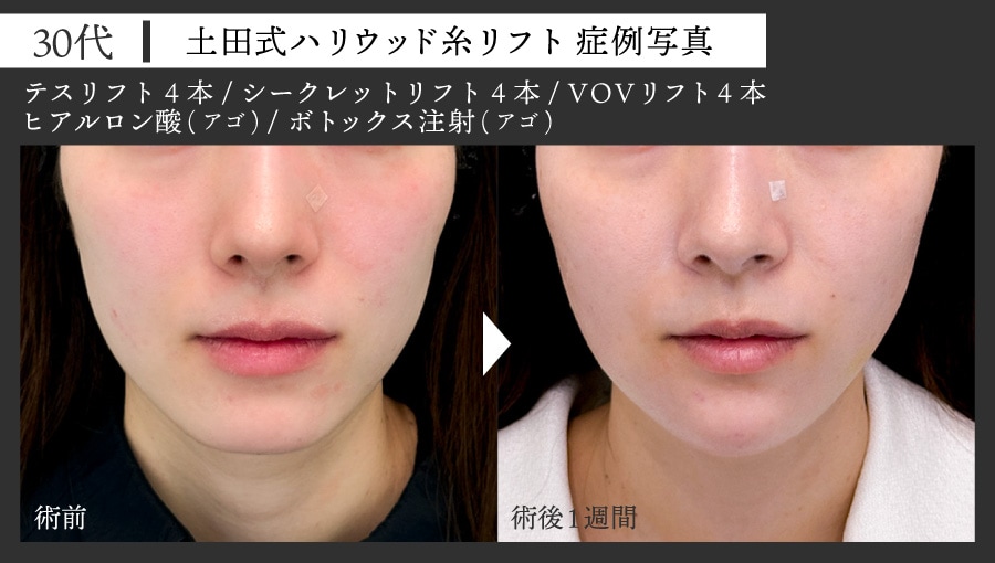 30代女性 糸リフト症例写真