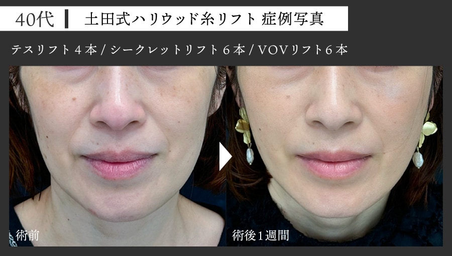 40代女性 糸リフト症例写真