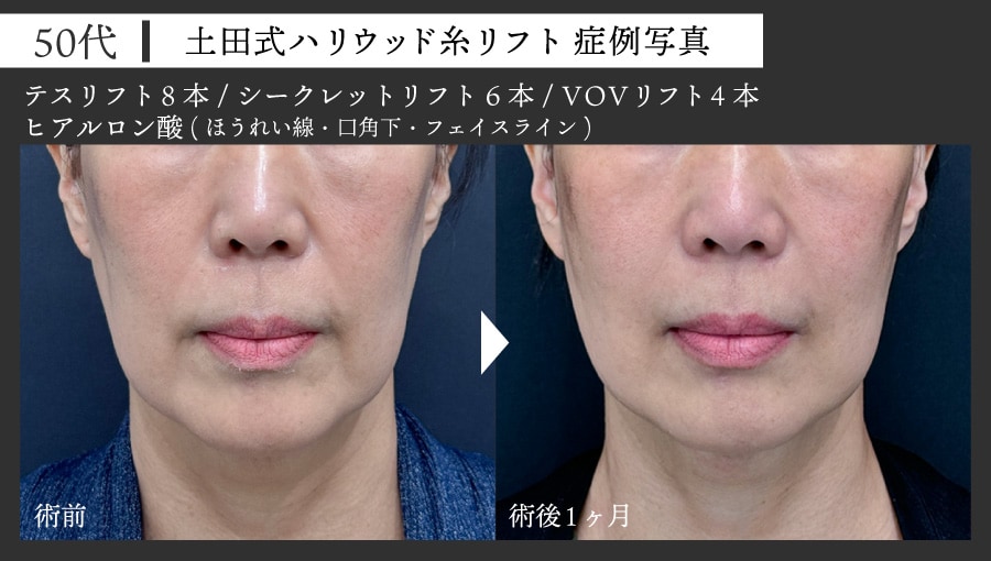 50代女性 糸リフト症例写真