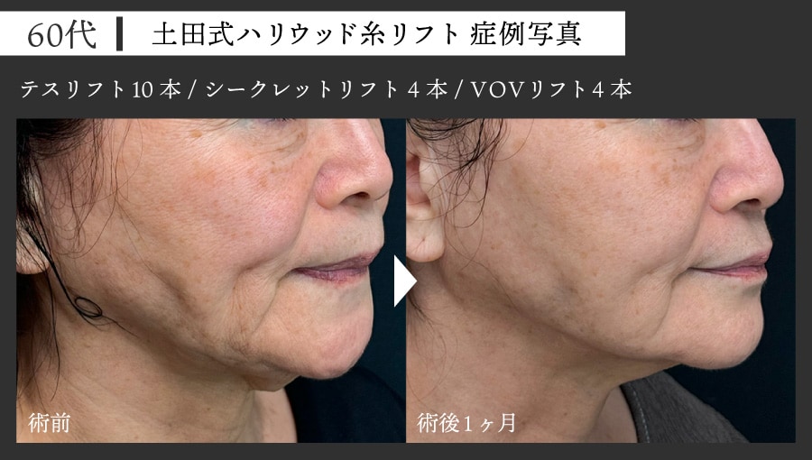 60代女性 糸リフト症例写真