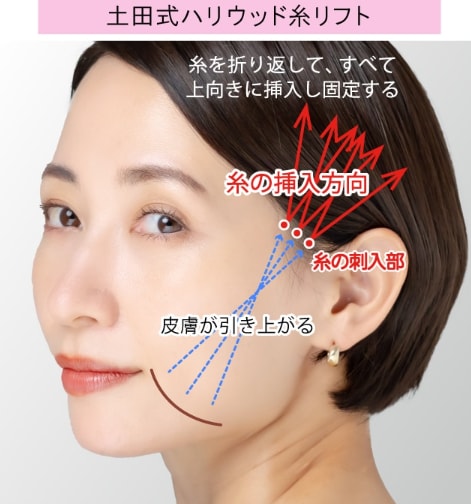 土田式ハリウッド糸リフトの挿入方法