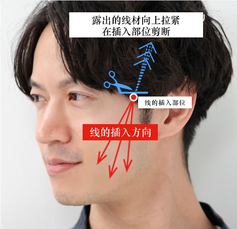 传统线雕提拉术提拉的插入方法<br />