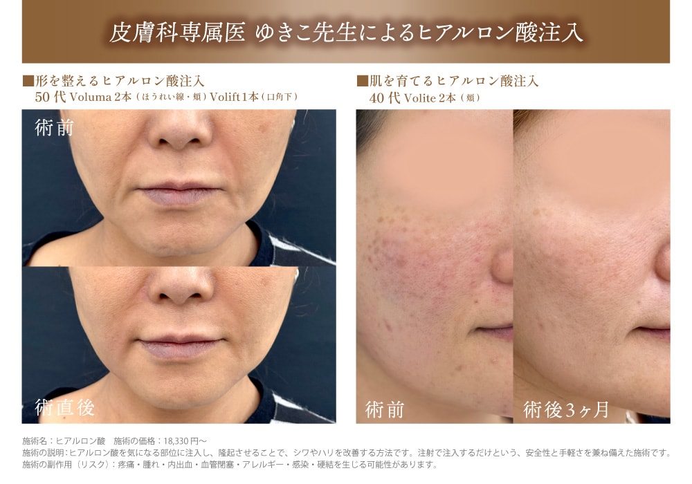 あなたはどっち?【ヒアルロン酸】で肌育 or 輪郭補正