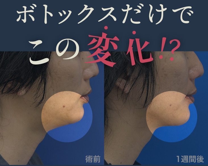 【院長が体験】ボトックスだけでこの変化！京都駅ビル院でダウンタイムほぼなしの小顔・リフトアップ術【ボトックスリフト】