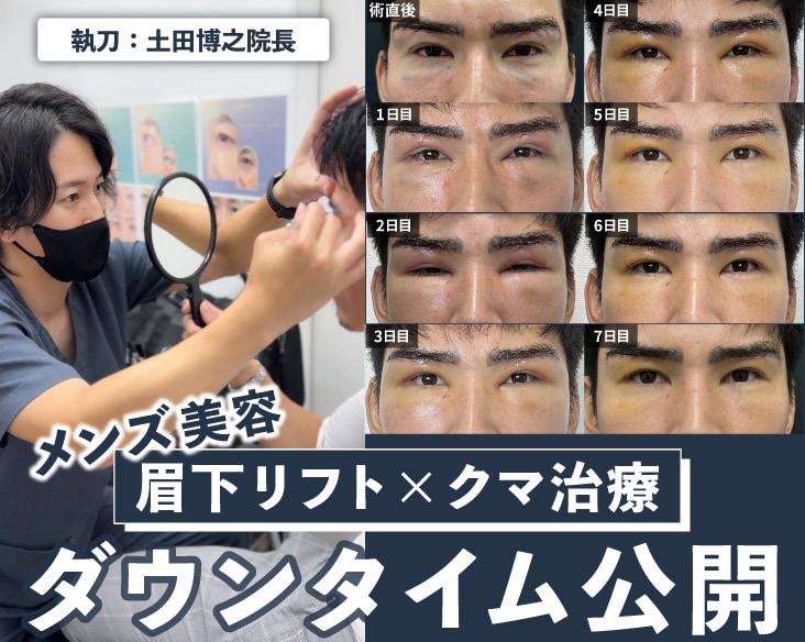 30代メンズ美容【クマ取り治療・眉下リフト】目元の若返りダウンタイム公開！
