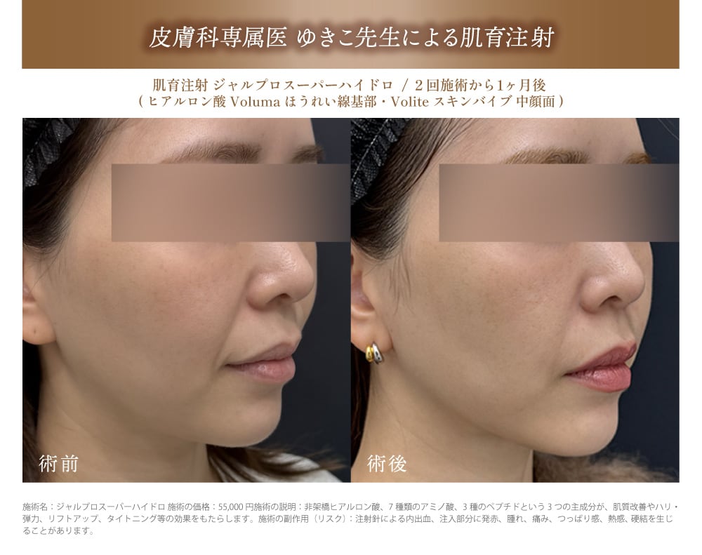 《たるみ・毛穴・乾燥小ジワ》肌タイプに合わせた肌育注射