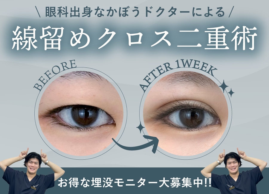 【10万円以下】持続性で選ばれる埋没法がお得に！