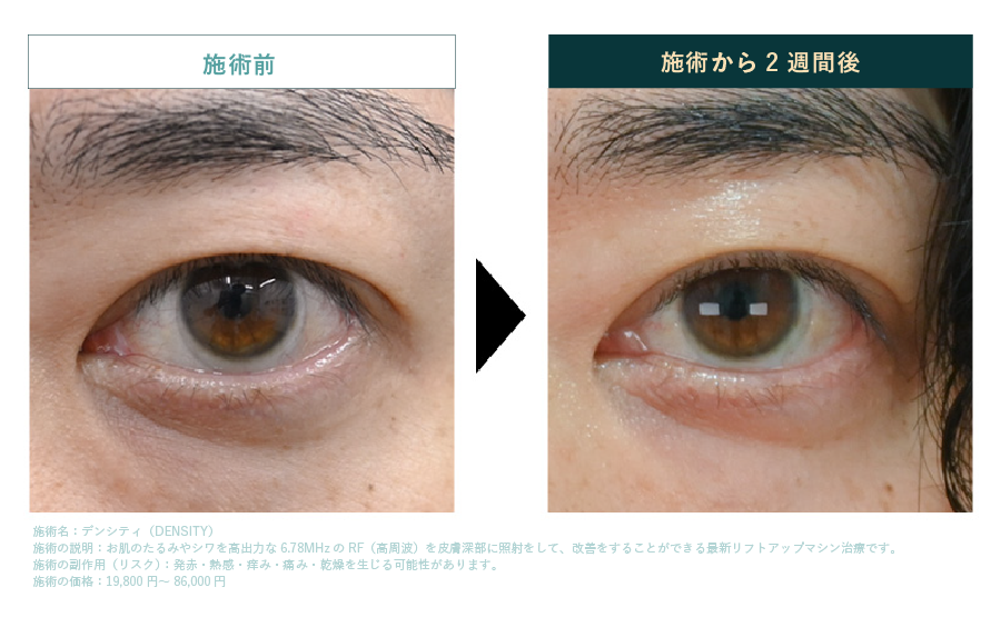 デンシティアイなら瞼の照射もOK
