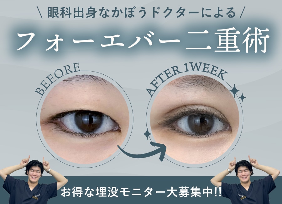 【10万円以下】持続性で選ばれる埋没法がお得に！