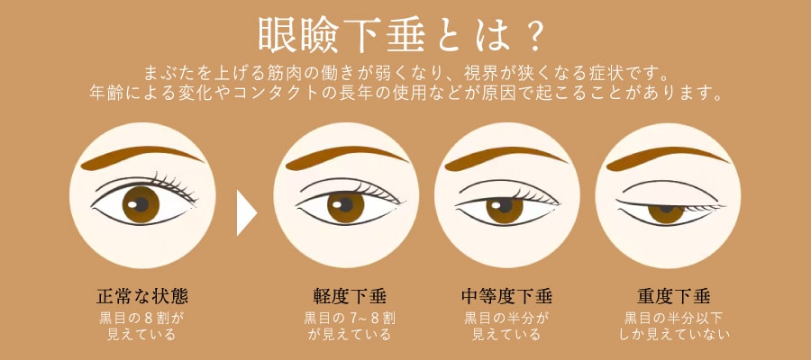 眼瞼下垂ってどんな症状？
