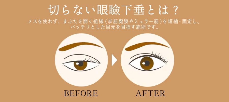 「切らない眼瞼下垂手術」はどんな施術？