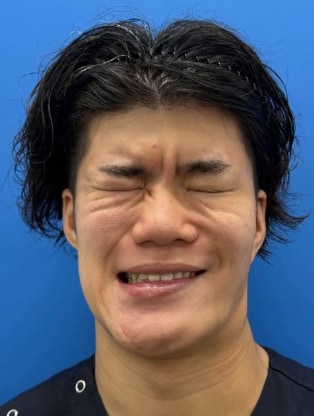 ☑Crow’s feet ＆bunny lines 