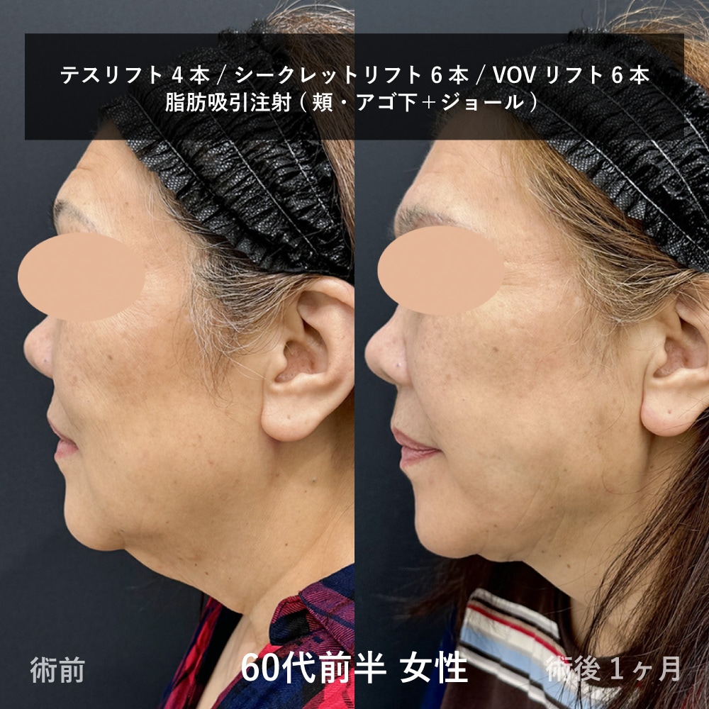 たるみと脂肪を同時に改善！