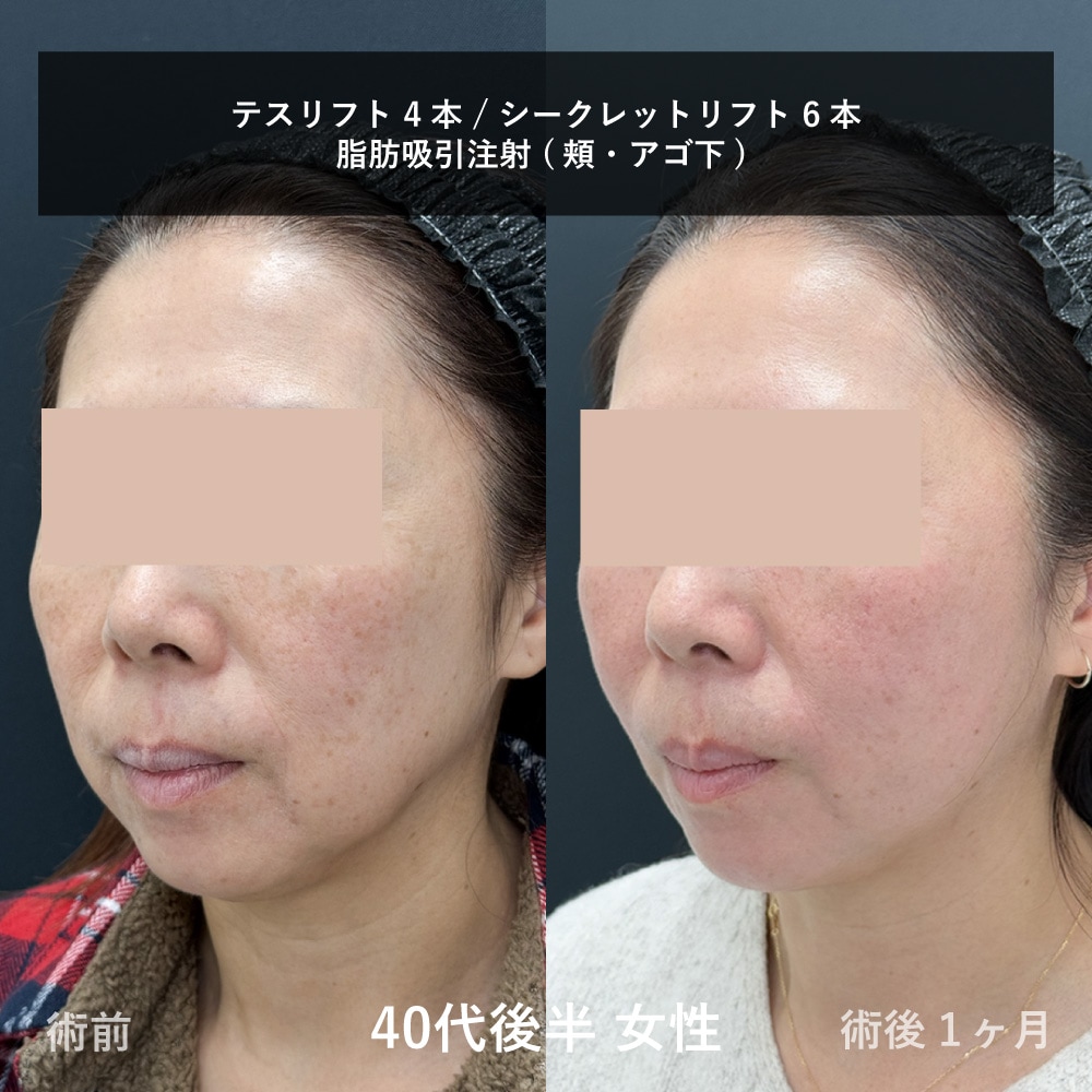 もたつき解消で輪郭の若返り！