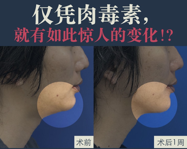 【★院长亲身体验★】仅靠肉毒竟然能有这样的变化！在京都站大楼院实现几乎零恢复期的小脸・提拉术【肉毒杆菌素提拉】