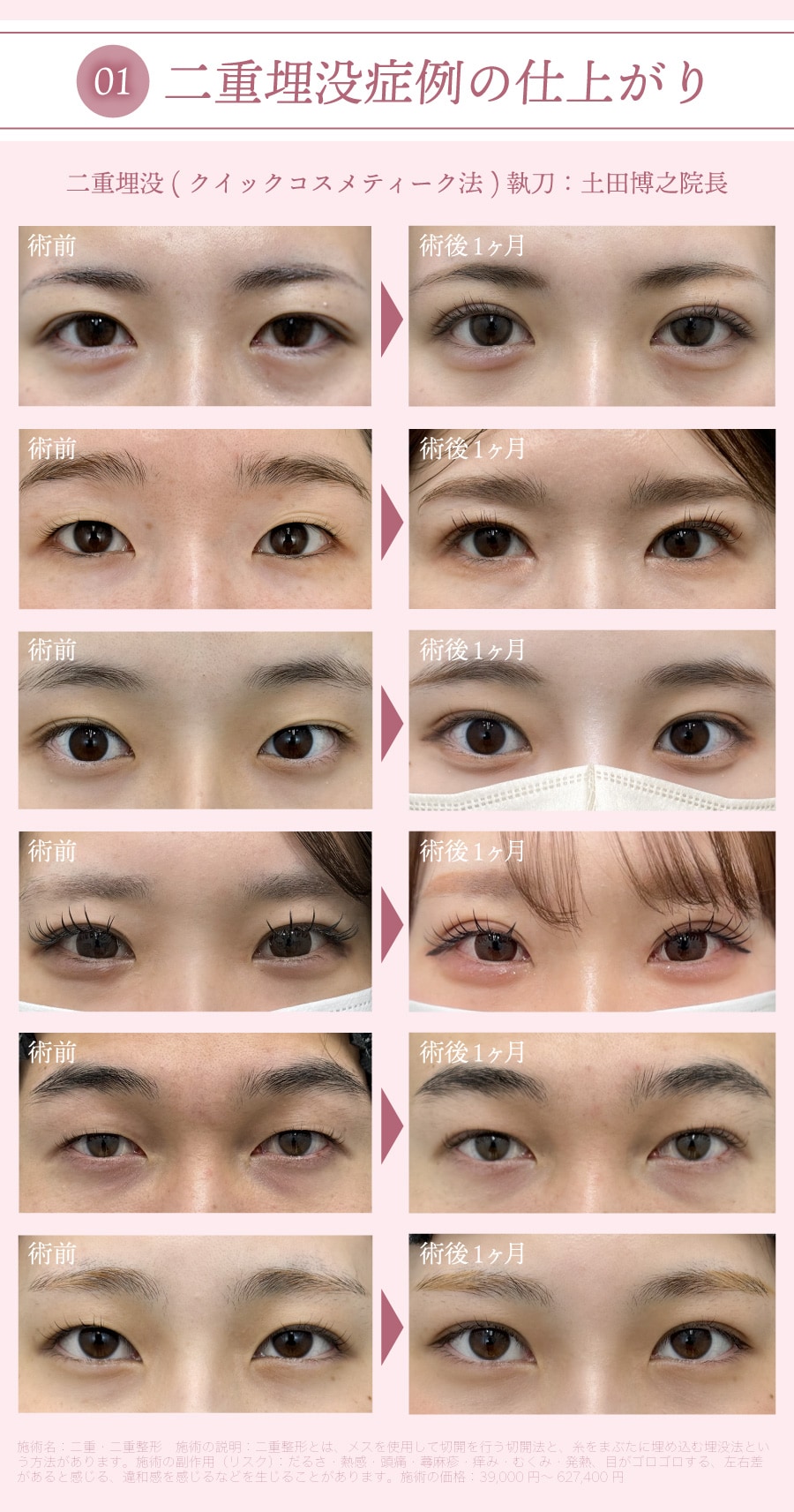 症例のキレイさで選ばれる土田院長の二重埋没