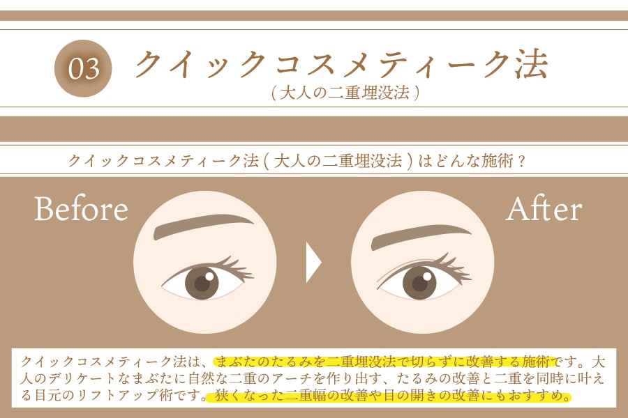 大人の埋没法 | クイックコスメティーク法ってどんな施術？<br />
