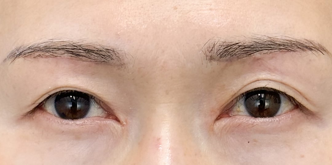眉下リフト(眉下切開)