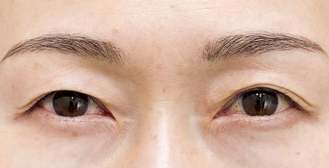 眉下リフト(眉下切開)