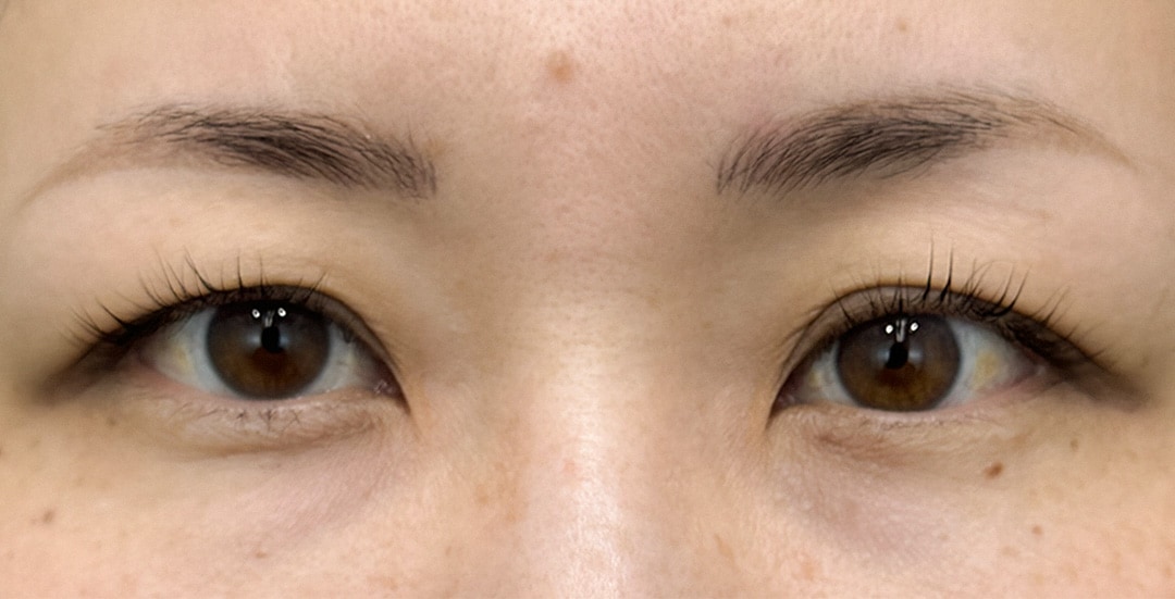 大人の二重術(クイックコスメティーク法)