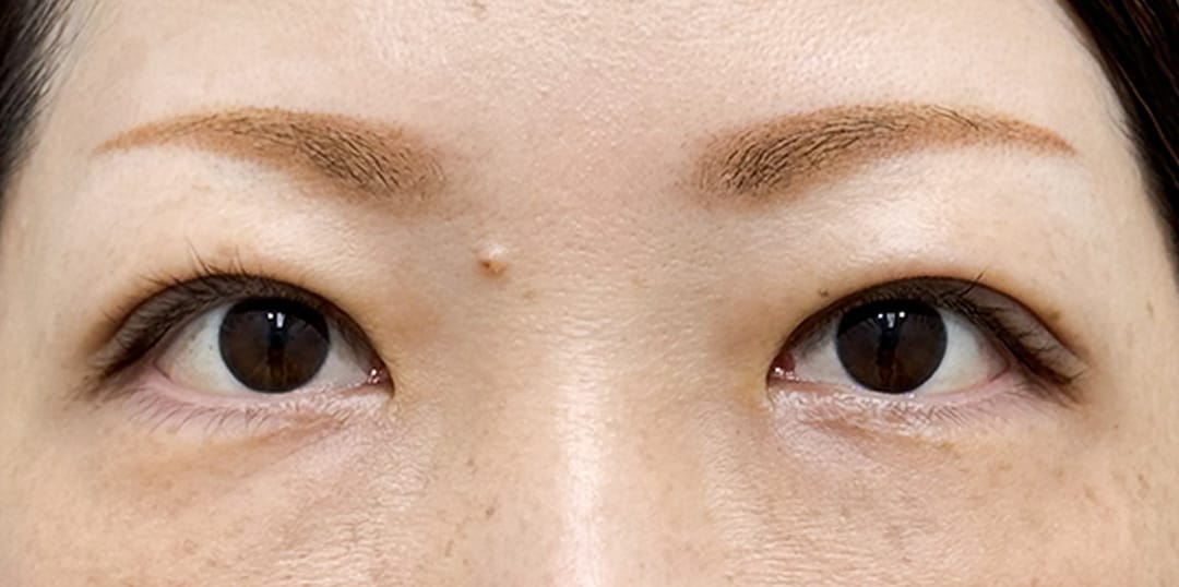 大人の二重術(クイックコスメティーク法)