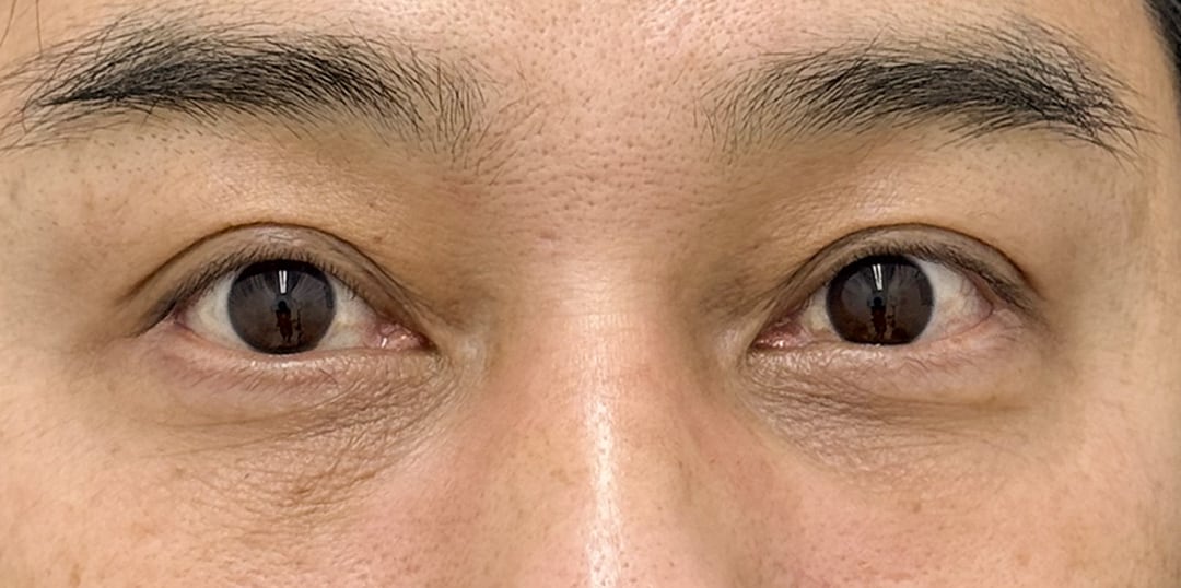 クマ治療(裏ハムラ法)