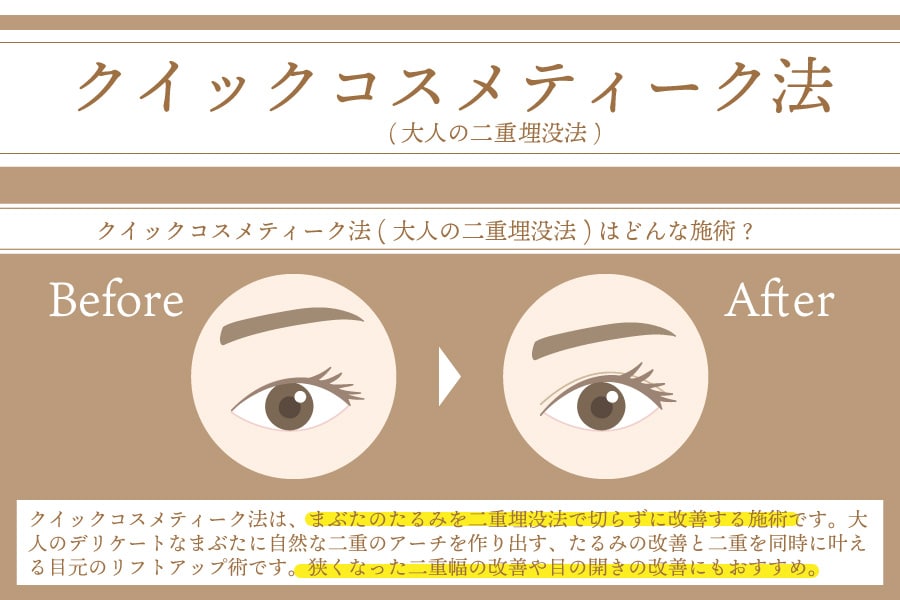 大人の埋没法 | クイックコスメティーク法ってどんな施術？<br />
