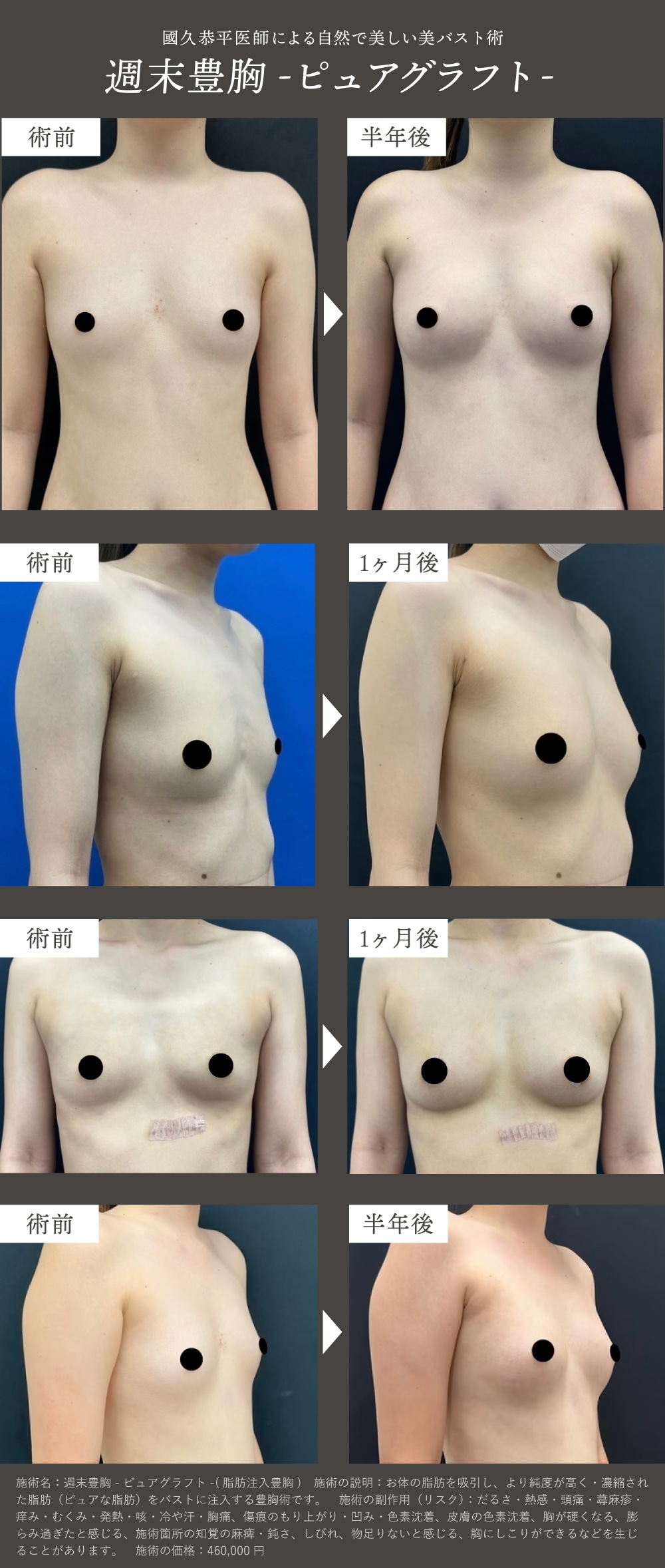 京都で美バストなら國久医師の脂肪注入豊胸！