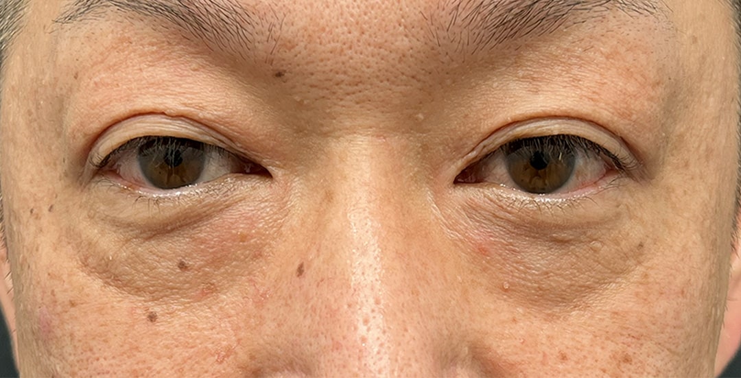 クマ治療(クマ取り＋脂肪注入)