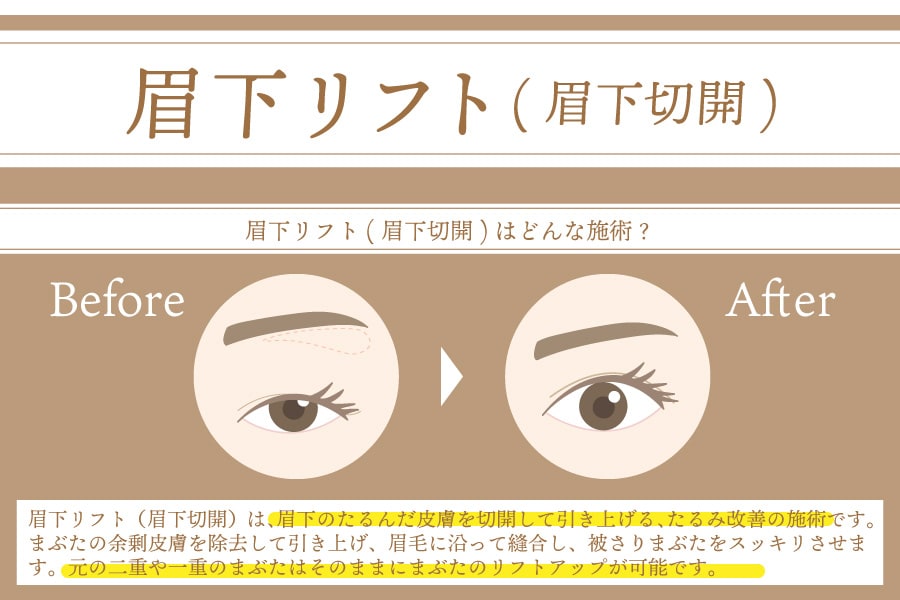 目元のエイジングケア | 眉下リフト(眉下切開)ってどんな施術？