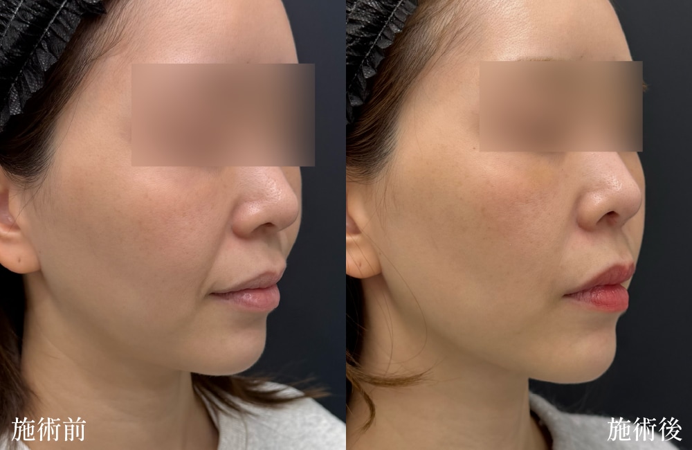 ほうれい線の緩和により老け見え解消！