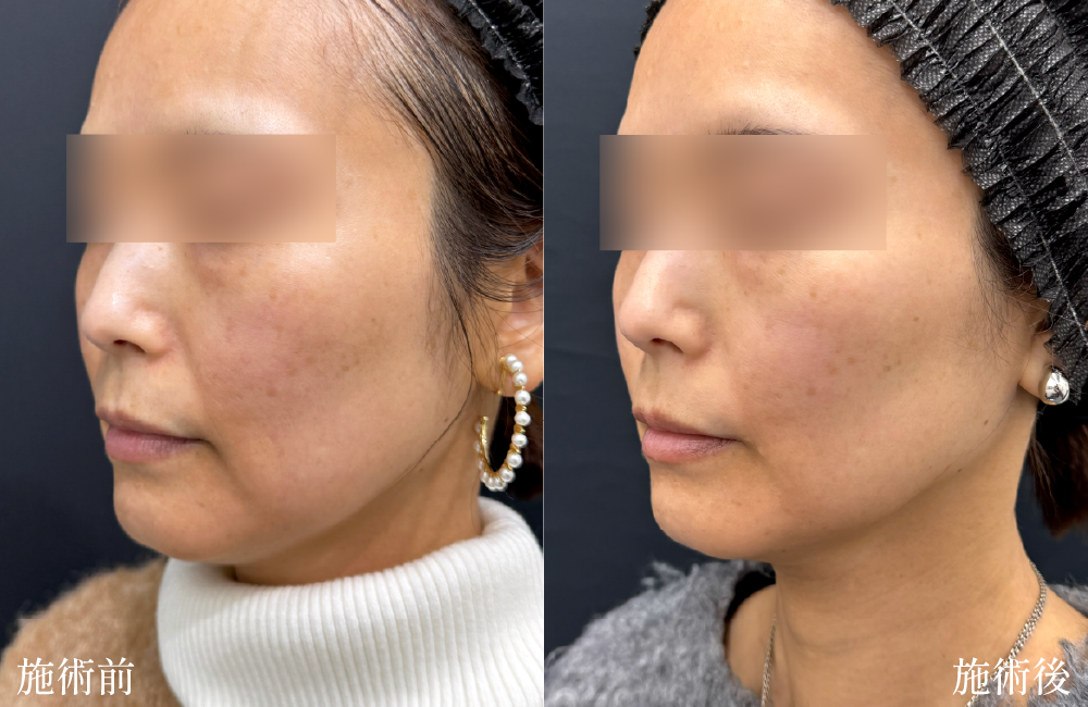 口元のもたつきが引き締まりスッキリとした印象に