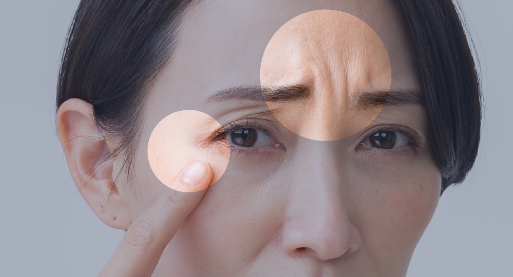 表情ジワの原因となる筋肉の動きを一時的に抑える若返り治療