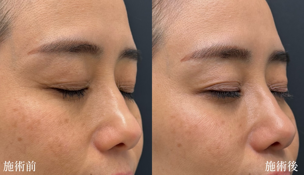 目尻のシワ＆目の下ふっくらで疲れた印象が改善！