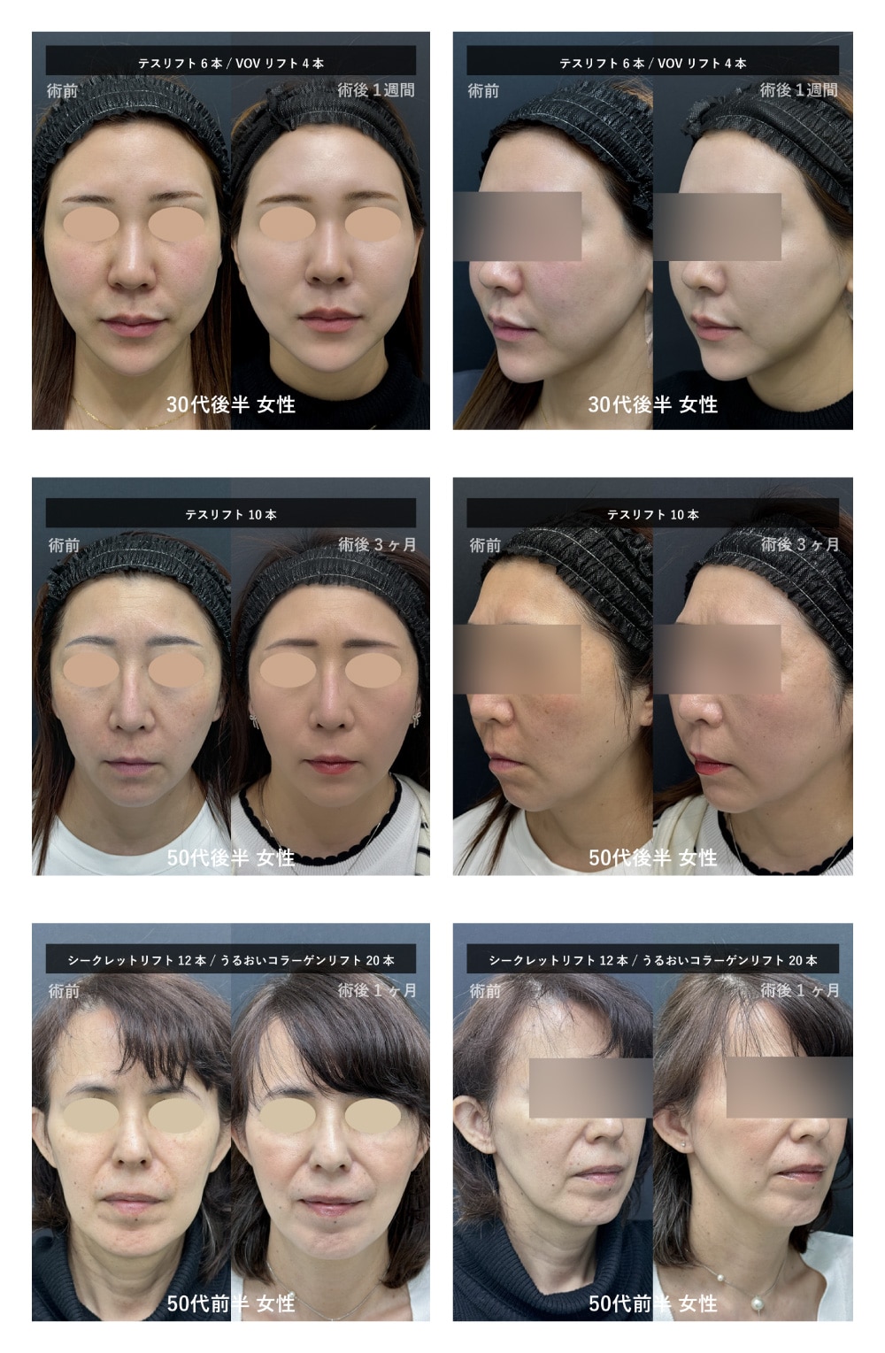 糸リフト新着P_症例【価格表】