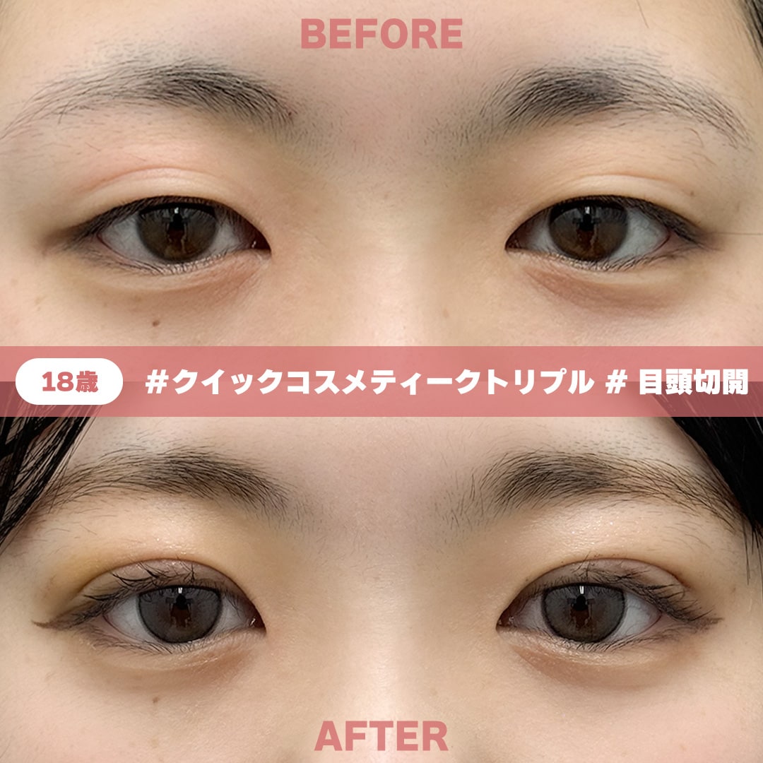 18歳 / クイックコスメティーク・トリプル + 目頭切開 / 術後1週間