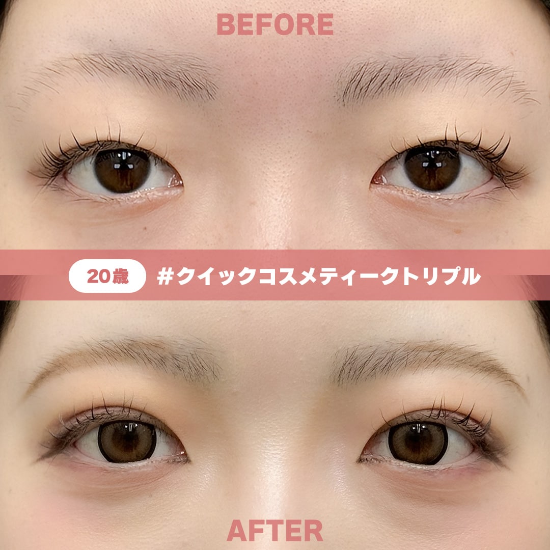 20歳 / クイックコスメティーク・トリプル / 術後1週間