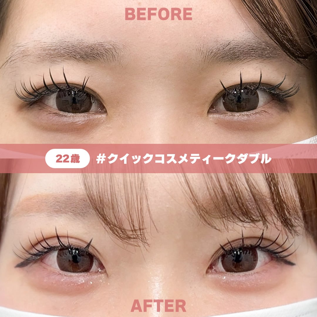 22歳 / クイックコスメティーク・ダブル / 術後1ヶ月