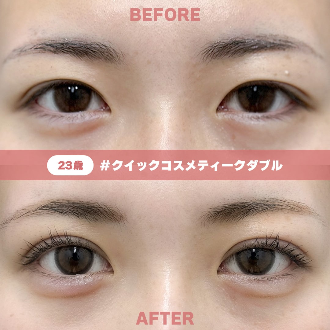 23歳 / クイックコスメティーク・ダブル / 術後1ヶ月