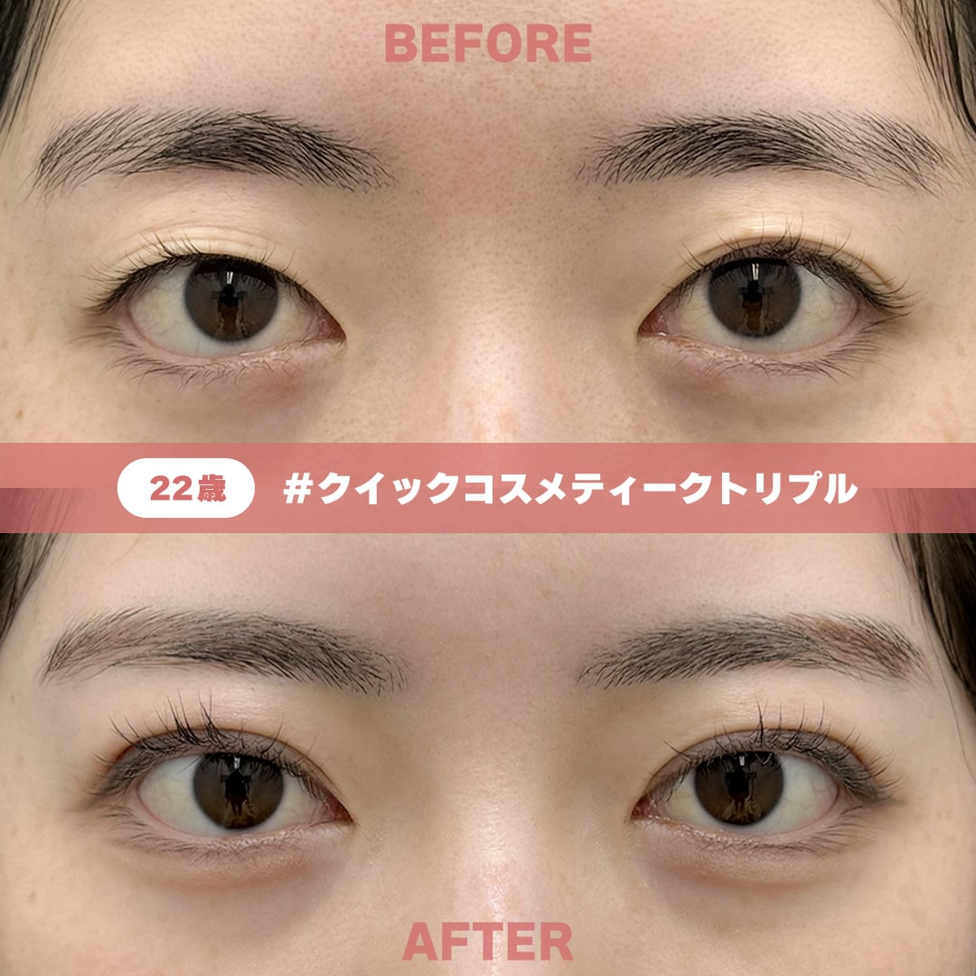 22歳 / クイックコスメティーク・トリプル / 術後1週間
