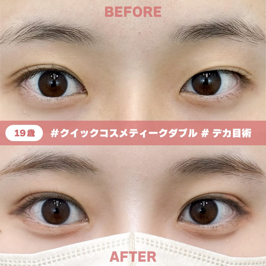 19歳 / クイックコスメティーク・ダブル / 術後1ヶ月