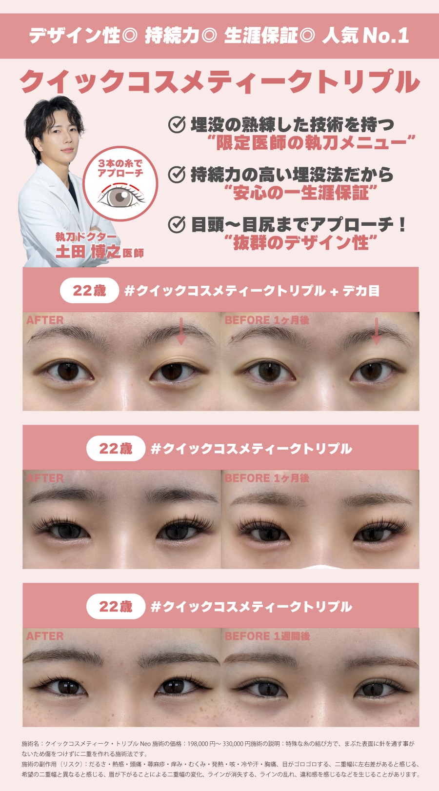 持続性・デザイン性抜群！一生涯保証の埋没法<br>クイックコスメティークトリプル</br>