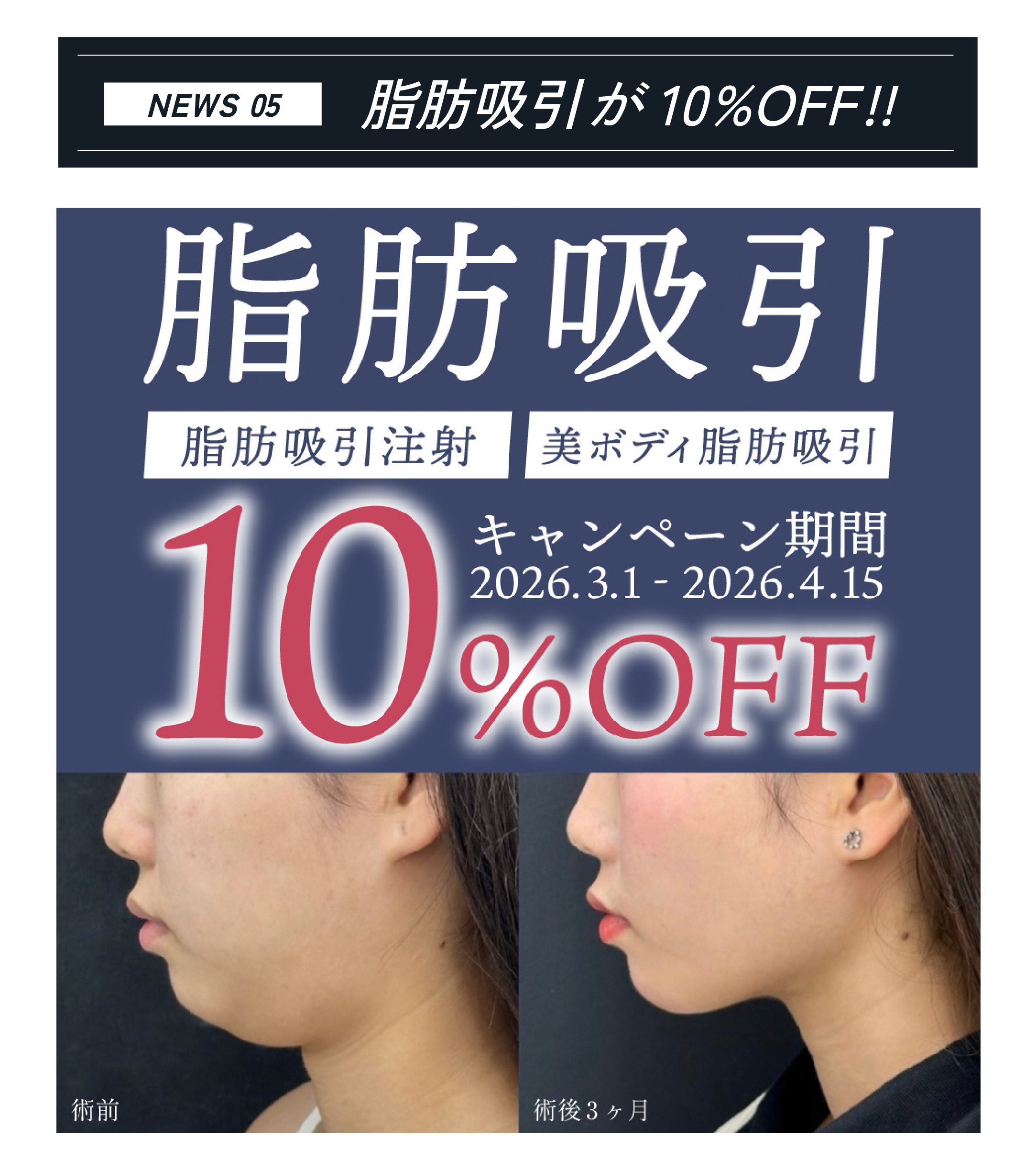 脂肪吸引10%OFF