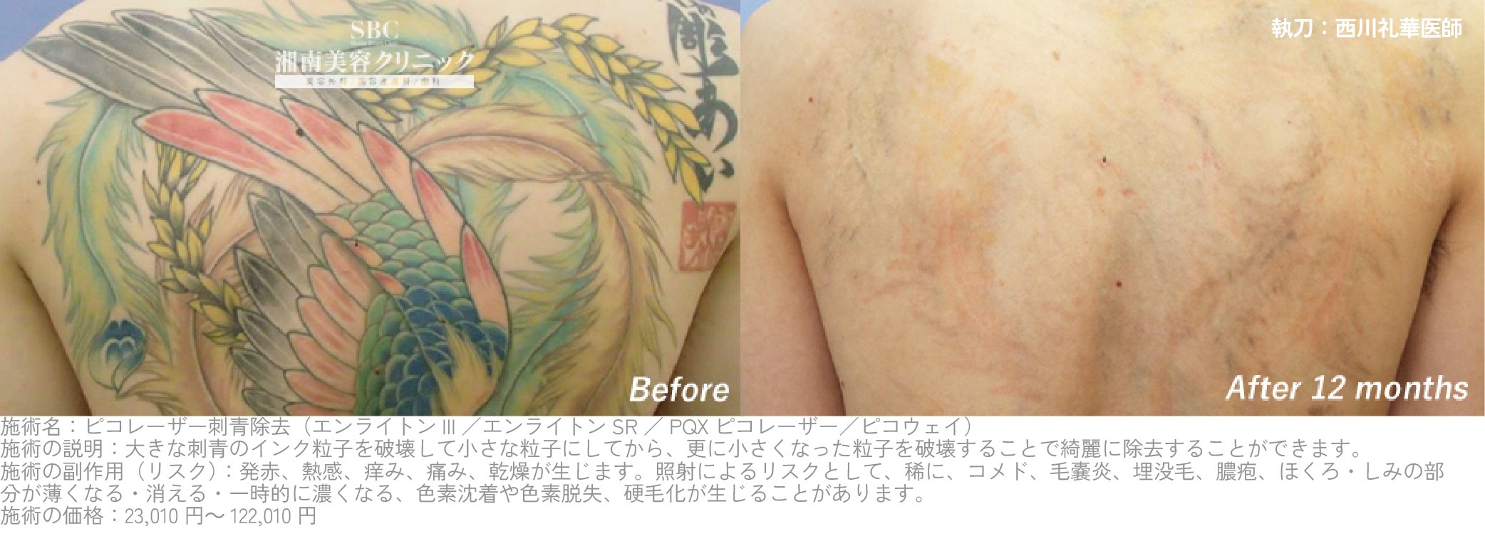 カラータトゥーにも対応